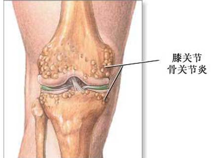 膝关节炎诊断标准是什么