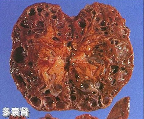 多囊肾可以买那种保险 多囊肾能买商业保险