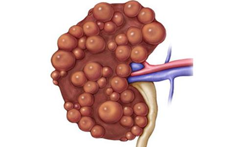 治疗多囊肾费用大概多少