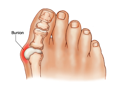 大拇指向外歪斜,患者买鞋子的时候是相当难买的,而且脚部的剧烈疼痛会