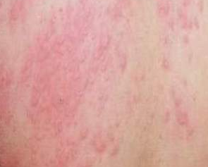螨虫引起的荨麻疹症状有哪些