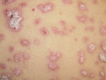 扁平苔藓是一种具有特征性的紫红色扁平丘疹,斑丘疹,呈慢性经过的