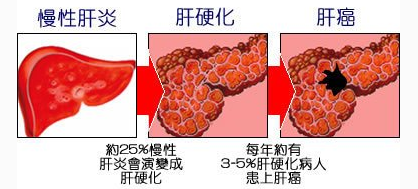 肝硬化早期可以治愈吗