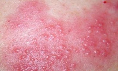 小儿湿疹是什么症状