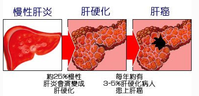 脂肪肝危害大吗