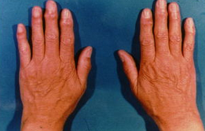 手关节炎是怎么引起的_飞华健康网