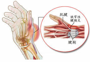 大拇指腱鞘炎做手术吗