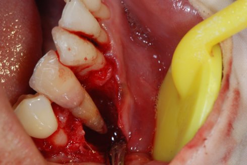 牙槽骨骨髓炎症状有哪些
