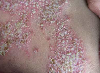 牛皮癣症状如何诊断