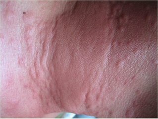 出疹第二天开始,面部及四肢皮疹可变成针尖样红点,如猩红热样皮疹.