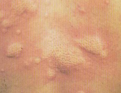 荨麻疹的病因与治疗方法