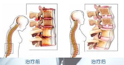 强直性脊柱炎可以治疗吗