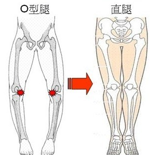 正常腿和o型腿区别图