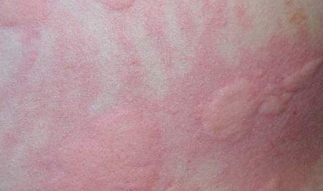 螨虫荨麻疹症状有哪些