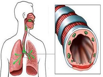 小儿慢性支气管哮喘