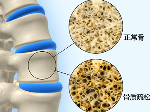 骨质疏松症最大的危害是什么