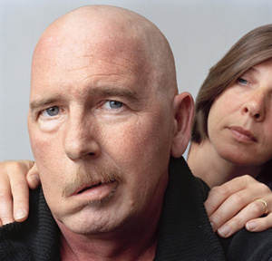 轻微面瘫的症状有哪些