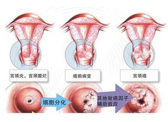 预防妇科病宫颈炎的方法