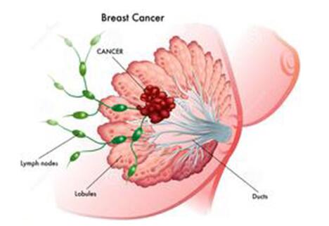 乳腺增生后遗症有哪些呢