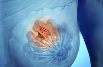 火疗治疗乳腺增生