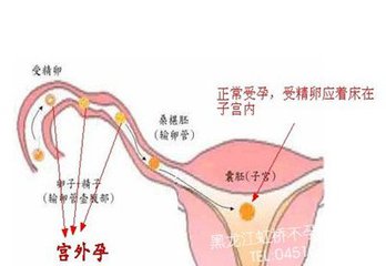 宫外孕可以怎么治疗