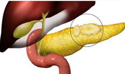 胰腺癌手术后遗症有哪些