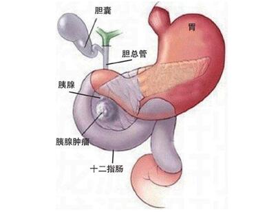 胰腺癌怎么诊断治疗