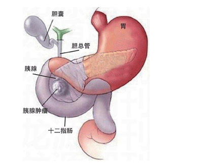 胆囊胰腺癌的症状及治疗