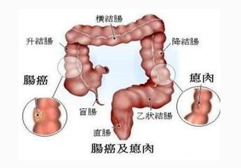 直肠癌手术后容易复发怎么办