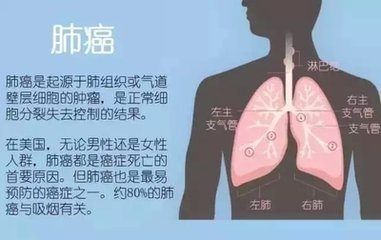 患上了肺癌早期能治愈吗