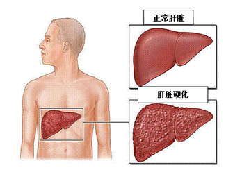 肝癌转移的类型有哪几种