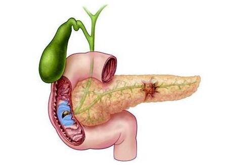 在胰腺癌出现腹水的时候,应及时改善腹水症状,而不