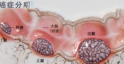 结肠癌哪家医院好