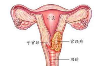 2,性行为分娩次数:比如初次性生活小于16岁,或者有多个性伴侣,以及