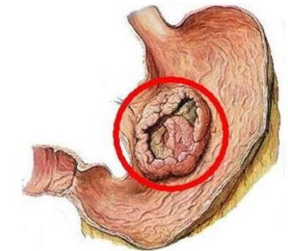 凹陷型早期胃癌的症状有哪些