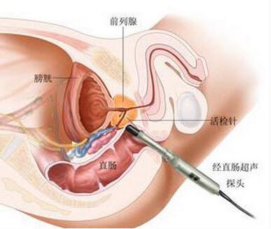 前列腺癌