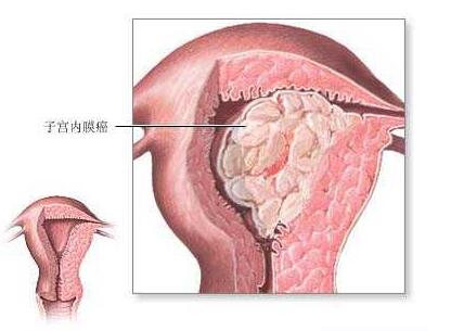 巴氏涂片检查宫颈癌的方法