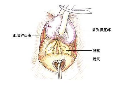 前列腺癌睾丸切除手术多少钱_飞华健康网