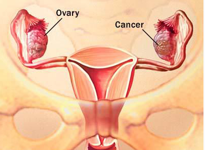 卵巢癌