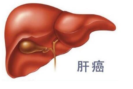 肝癌治疗选哪个医院