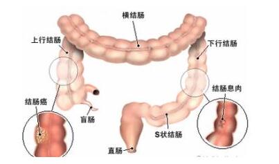 结肠癌对怀孕有影响吗