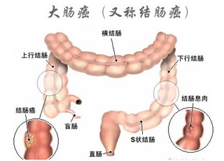 肠癌