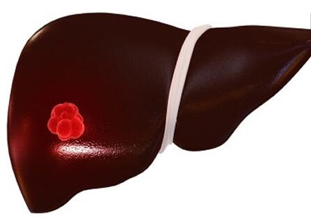 了解一下肝癌晚期传染吗