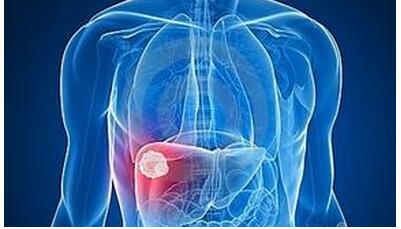肝癌的早期肝功能检查