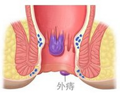 外痔和肛周脓肿区别