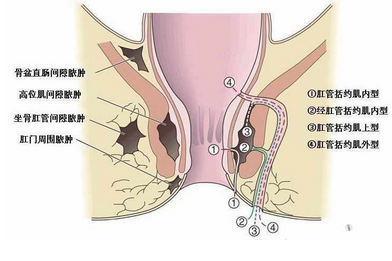 肛周脓肿危害很大