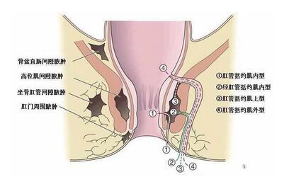 肛周脓肿发生后应认真对待,发生在肛门两侧的坐骨直肠窝和骨盆直肠窝