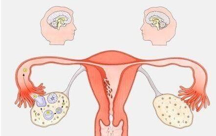 多囊卵巢综合征有哪些原因