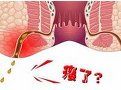 很多肛瘘患者都以为肛瘘能够自愈,以至于在短期内就把单纯性肛瘘形成