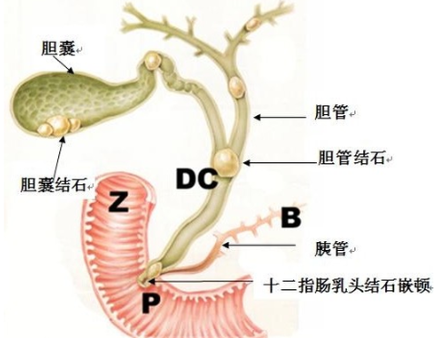 老年人结石病的危害